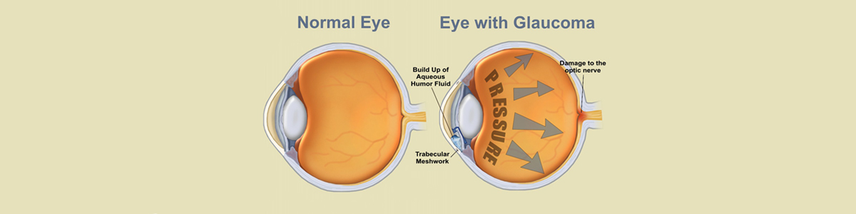 Glaucoma; tipos, síntomas y tratamientos